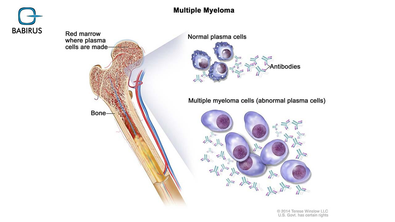 Multiple Myeloma cells | Babirus