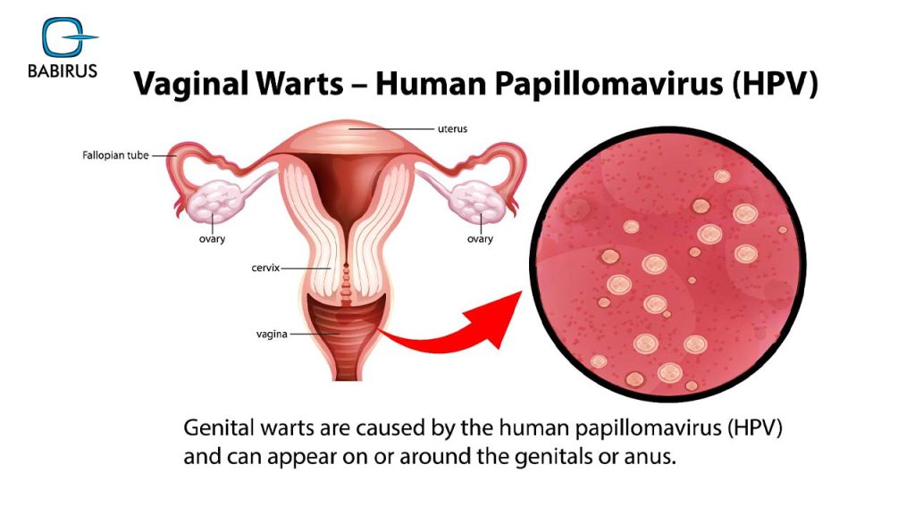 The Complete Guide to Human Papillomavirus (HPV) – Symptoms, Causes, and Treatment