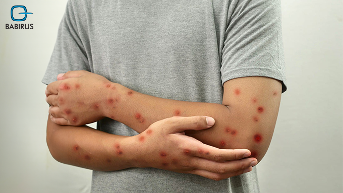 Monkeypox
