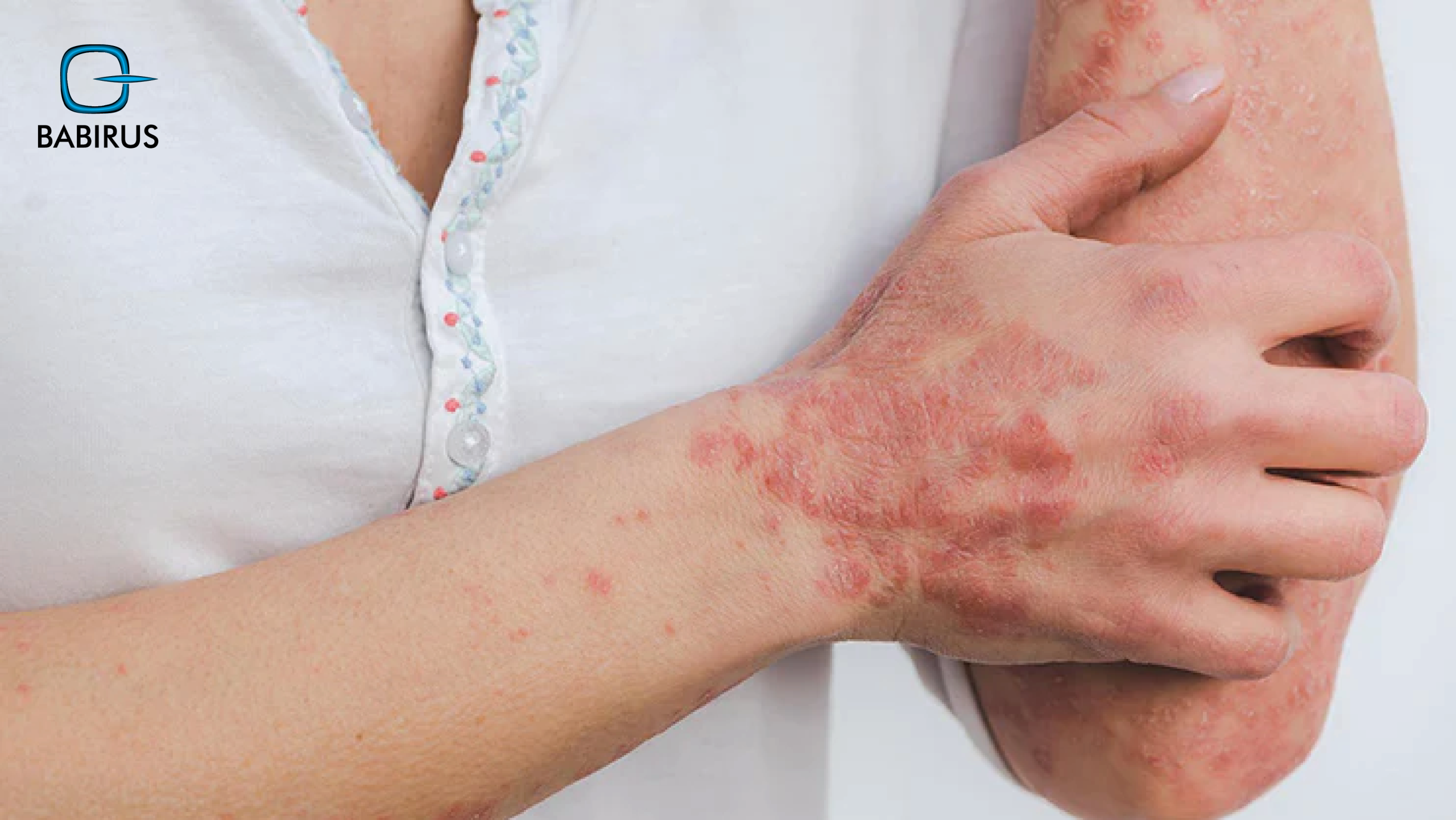 Eczema and Gut Health: How Digestive Imbalance Affects Skin Conditions