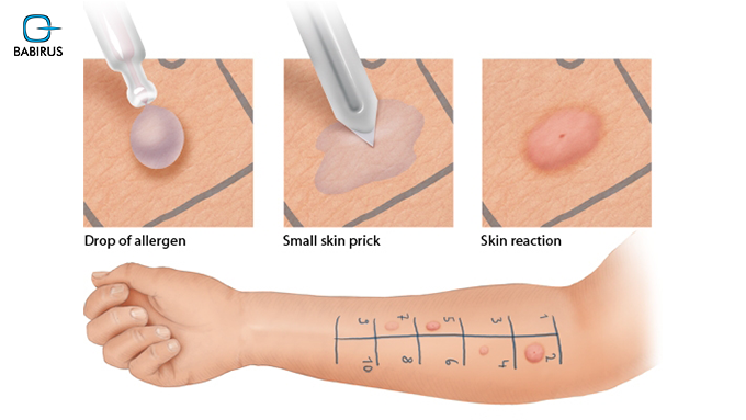 Allergic Endotypes in Biologic Prescribing: The 2026 Guide for UAE Labs 1 Allergic Endotypes in Biologic Prescribing: The 2026 Guide for UAE Labs URL Slug: /allergic-endotypes-biologic-prescribing/ Meta title: Allergic Endotypes vs Phenotypes: Precision Biologic Prescribing 2026 Meta Description: Stop biologic treatment failure. Discover how identifying allergic endotypes in biologic prescribing reduces insurance denials and improves patient outcomes in the UAE using MADx molecular diagnostics. Primary Keyword: Allergic endotypes in biologic prescribing, Molecular allergy testing As the UAE healthcare landscape evolves toward the 2031 vision of precision medicine, the clinical management of severe asthma and allergic disease is undergoing a fundamental shift. For years, clinicians relied on phenotypes; the observable characteristics of a disease, to guide treatment. However, in 2026, it is becoming increasingly clear that two patients with the same "severe allergic asthma" phenotype may respond very differently to the same biologic therapy. To achieve better clinical outcomes and satisfy the rigorous requirements of modern insurance reimbursement in Dubai and Abu Dhabi, we must look deeper. We must move from phenotypes to allergic endotypes. This blog explores the critical role of molecular mapping in identifying these biological pathways, the necessity of precision diagnostics for biologic eligibility, and how advanced tools are streamlining the transition from generalized care to targeted therapy. Defining the Shift: Phenotypes vs. Endotypes A phenotype describes what we see: a patient with frequent wheezing, high rescue inhaler use, and perhaps a history of atopy. An endotype, conversely, describes the functional and pathobiological mechanism that causes those symptoms. In the era of targeted biologics, treating a phenotype is like trying to fix a car engine by only looking at the smoke from the exhaust. Treating an endotype is like plugging in a diagnostic computer to find the exact sensor that failed. For specialists in the GCC, identifying these specific pathways is no longer a luxury; it is a clinical necessity for biologic prescribing. The 2026 Standard for Biologic Prescribing The biologics available today, such as anti-IgE, anti-IL-5, and anti-IL-4/IL-13 therapies, are highly specific. Their efficacy depends entirely on whether the patient’s underlying inflammatory driver matches the drug's mechanism of action. • Anti-IgE (Omalizumab): Primarily targets the IgE-mediated pathway. • Anti-IL-5 (Mepolizumab, Benralizumab): Focuses on eosinophilic inflammation. • Anti-IL-4/IL-13 (Dupilumab): Blocks the shared receptor for cytokines driving T2-high inflammation. If a clinician prescribes an anti-IL-5 biologic to a patient whose severe asthma is driven by a non-eosinophilic endotype, the treatment will likely fail, leading to "diagnostic leakage", the clinical failure to correctly identify a condition (misdiagnosis), and wasted healthcare resources. This is why allergic endotypes in biologic prescribing has become the primary focus for UAE lab managers and pulmonologists. Why Phenotypes Fall Short in Precision Medicine Phenotypes are often "noisy." A patient might present with an allergic phenotype due to environmental triggers in the UAE, such as desert dust or AC mold, but their internal endotype might actually be "T2-low" or neutrophilic. Relying on observable traits alone can lead to several clinical pitfalls: 1. Ineffective Treatment Cycles: Patients may spend months on expensive biologics that do not address their specific molecular driver. 2. Insurance Denials: In 2026, UAE insurers increasingly demand "molecular proof" of an endotype before approving high-cost therapies. 3. Incomplete Remission: Without targeting the root mechanism, the patient may achieve symptom relief but continue to suffer from underlying airway remodeling. The Role of MADx Molecular Allergy Testing To bridge the gap between "what we see" and "what is happening," advanced diagnostics are required. This is where MADx molecular allergy testing becomes a transformative tool for the modern laboratory. Unlike traditional extracts that provide a broad overview of sensitization, the MADx ALEX3® platform utilizes Component-Resolved Diagnostics (CRD). By testing for 295+ allergen components and total IgE simultaneously, it allows clinicians to map the exact molecular profile of a patient's sensitivity. Identifying the "T2-High" Endotype The most common endotype in severe asthma is T2-high inflammation. This pathway is characterized by elevated IgE and eosinophil counts. Using MADx molecular allergy testing, clinicians can confirm if a patient’s T2-high status is truly IgE-mediated. This distinction is vital for deciding between an anti-IgE biologic and an anti-IL-4/IL-13 biologic. Eliminating Cross-Reactivity Confusion Traditional skin prick tests or extract-based blood tests can show "false positives" due to cross-reactive proteins like profilins or PR-10. MADx technology includes powerful CCD (Cross-reactive Carbohydrate Determinants) blockers, ensuring that the results reflect true sensitization rather than irrelevant cross-reactivity. This precision is essential when establishing the clinical justification for a specific biologic endotype. Increasing Insurance Approval Rates for Biologics in the UAE The financial landscape of UAE healthcare is more scrutinized than ever. With the integration of genomic and diagnostic data into platforms like Malaffi, there is a "digital trail" for every clinical decision. For a hospital or private clinic, the business potential of utilizing endotype-based diagnostics is clear. By using MADx molecular allergy testing to prove biologic eligibility, providers can: • Increase Approval Rates: Presenting an insurer with a comprehensive molecular map of a patient's endotype makes a "denial" much harder to justify. • Improve Patient Retention: Fast, accurate results lead to "Day 1" precision, preventing patients from seeking second opinions at competing facilities. • Optimize Lab Throughput: Automated platforms like those provided by MADx allow for high-throughput testing with minimal hands-on time, a critical factor for labs facing staffing shortages. Moving Toward "Theratypes" The ultimate goal of endotyping is the creation of a "theratype", a prediction of treatment response based on the patient's unique biological pathways. When a clinician in Dubai or Abu Dhabi orders a molecular panel, they are no longer just asking "is this patient allergic?" They are asking "which biologic will provide the highest probability of remission?" This shift is particularly relevant for the pediatric population. Early endotyping in children can identify the "Allergic March" before it progresses to severe, irreversible asthma. By intervening with the right biologic at the right time, we can fundamentally change the trajectory of a patient's life. Conclusion, In 2026, the term "Allergy" is being replaced by a more nuanced understanding of molecular interactions. For Babirus, the mission is clear: provide the tools that turn clinical suspicion into molecular certainty. By moving beyond phenotypes and embracing allergic endotypes in biologic prescribing, the UAE healthcare community is setting a global standard for excellence. Whether it is through the deployment of the MADx ALEX3® system or the integration of AI-driven interpretive software, the focus remains on the individual patient. The era of "one size fits all" is over. The era of the endotype has arrived.