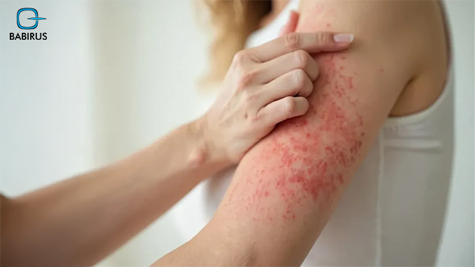 Allergic Endotypes in Biologic Prescribing: The 2026 Guide for UAE Labs